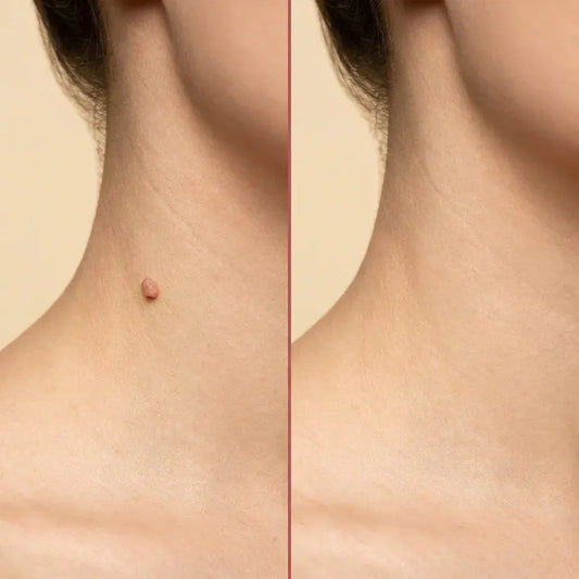 Bellbexa® Microneedle Botanic Skin Tag Solution Patch
