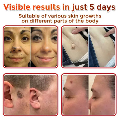 Bellbexa® Microneedle Botanic Skin Tag Solution Patch