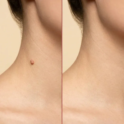 Bellbexa® Microneedle Botanic Skin Tag Solution Patch